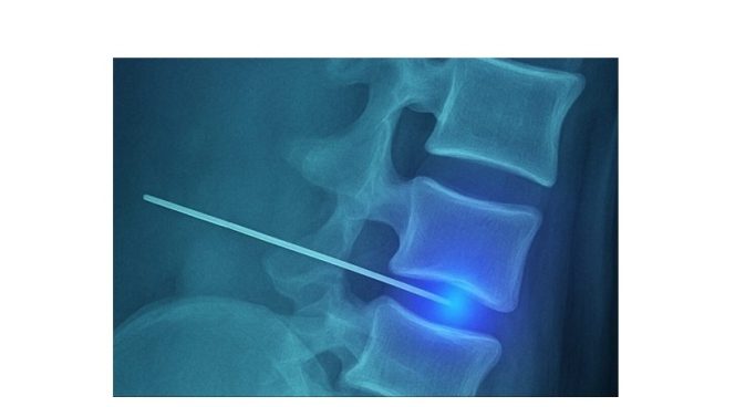 SpinaFX Medical receives FDA Investigational Device Exemption (IDE) for Triojection®, its Breakthrough, Minimally-Invasive, Image-Guided Lumbar Disc Treatment.