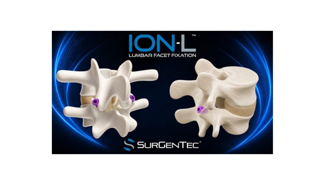 SurGenTec® Receives FDA Clearance for ION-L™, a Novel Lumbar Facet Fixation System Representing a Paradigm Shift in Minimally Invasive Spine Surgery
