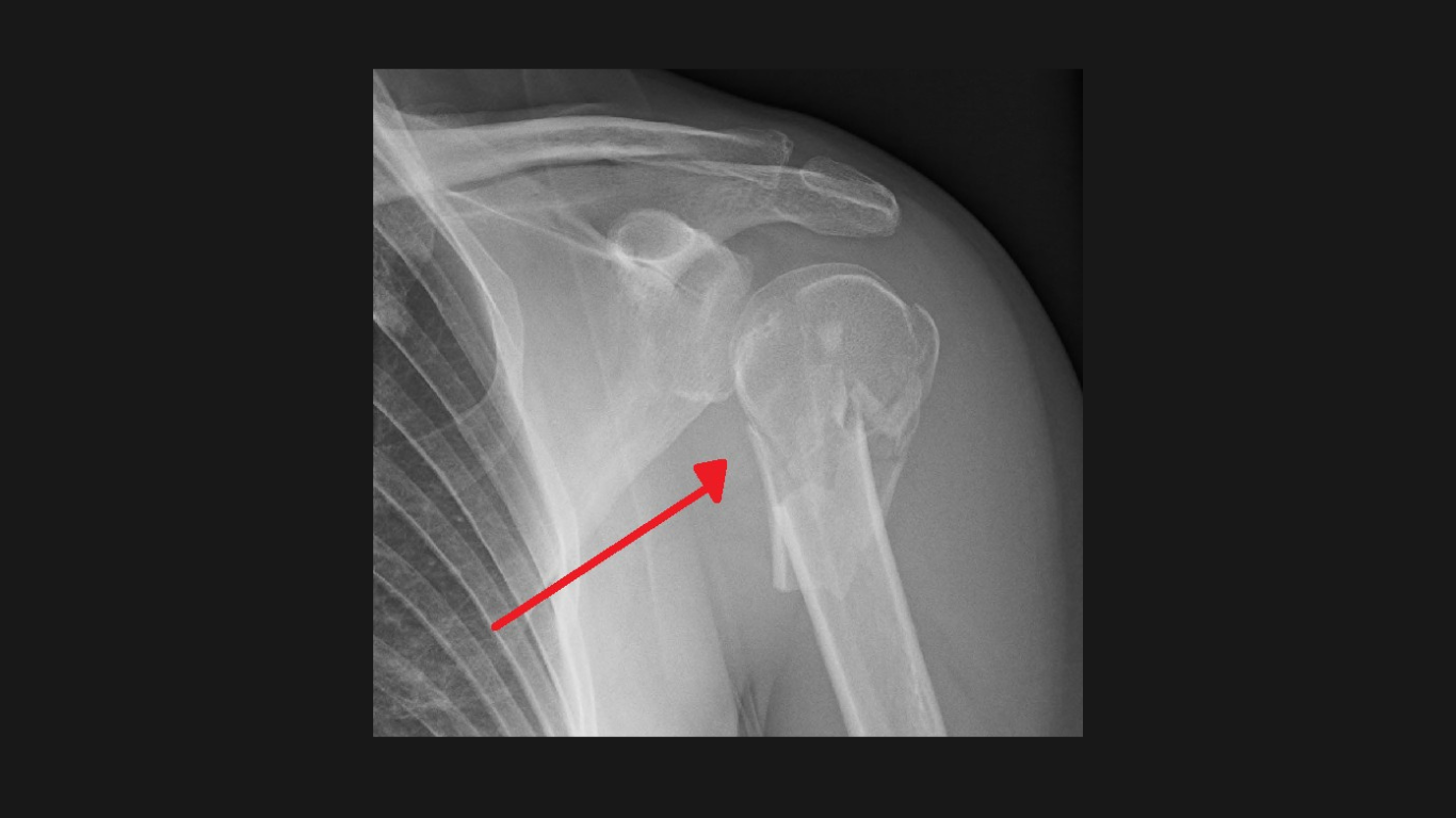 Use Reverse Shoulder to Fix Proximal Humerus Fractures?