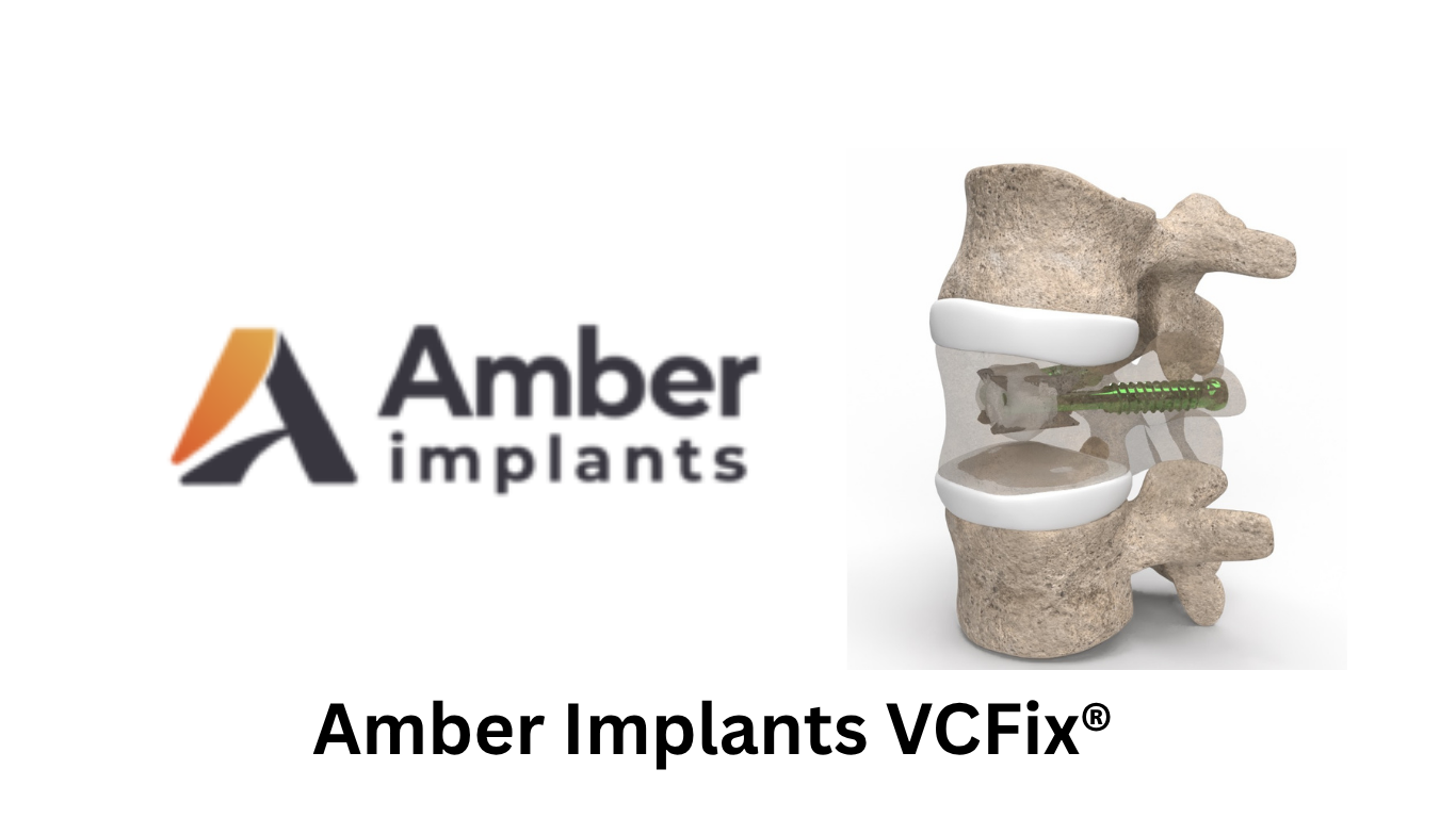 Amber Implants Advances Pivotal European EXPAND Study of VCFix® Spinal System in Standalone Vertebral Reconstruction
