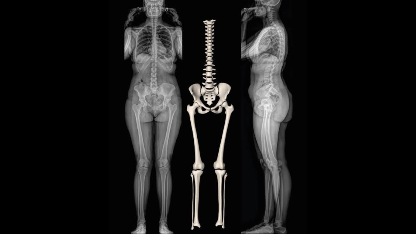 Can EOS Spot Sarcopenia Faster?