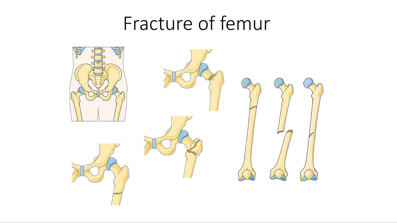 Femoral Fracture Complication Rates Post THA: New Study
