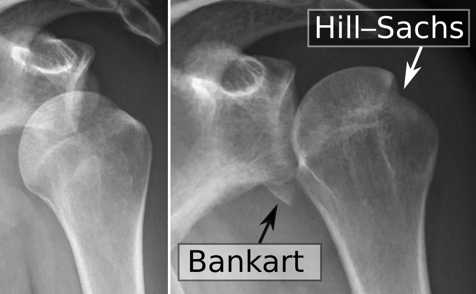 When a Seizure Dislocates a Shoulder: Complex Is Where These Start