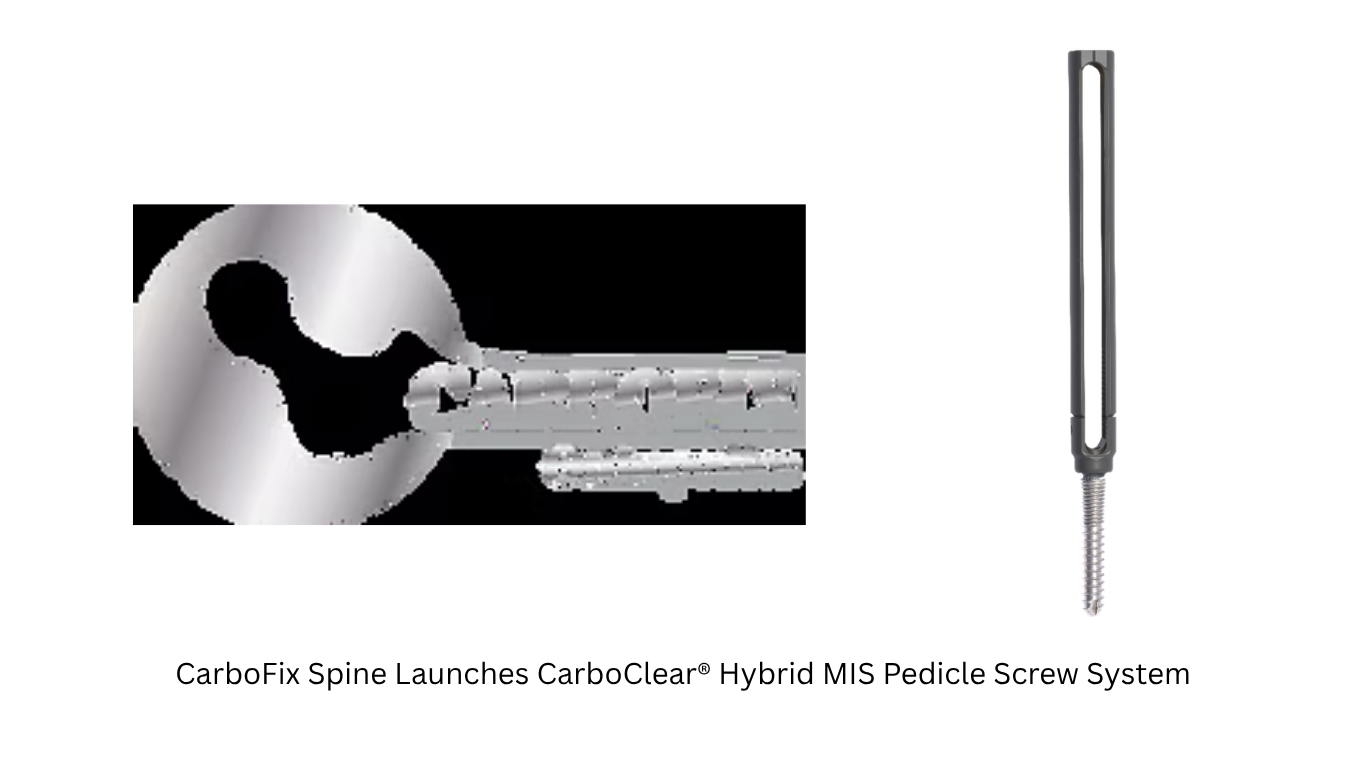 CarboFix Spine Launches CarboClear® Hybrid MIS Pedicle Screw System Advancing Minimally Invasive Spine Surgery with Carbon Fiber Hybrid Technology