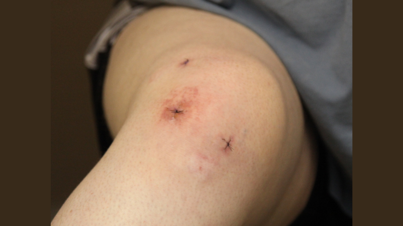 Second Chances for the Meniscus: Repair the Re-Tear, Ditch the Shaver?