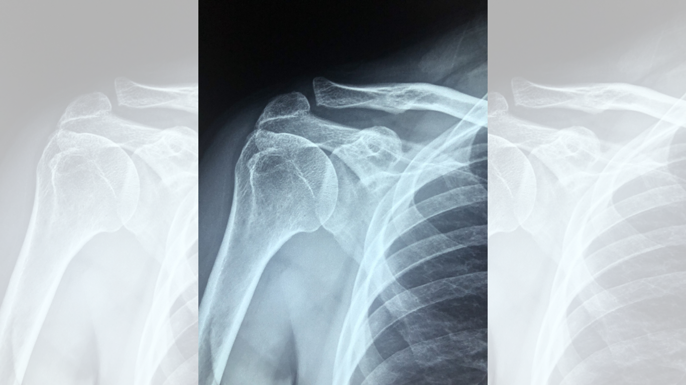 The Second Clavicle Break Nobody Wants