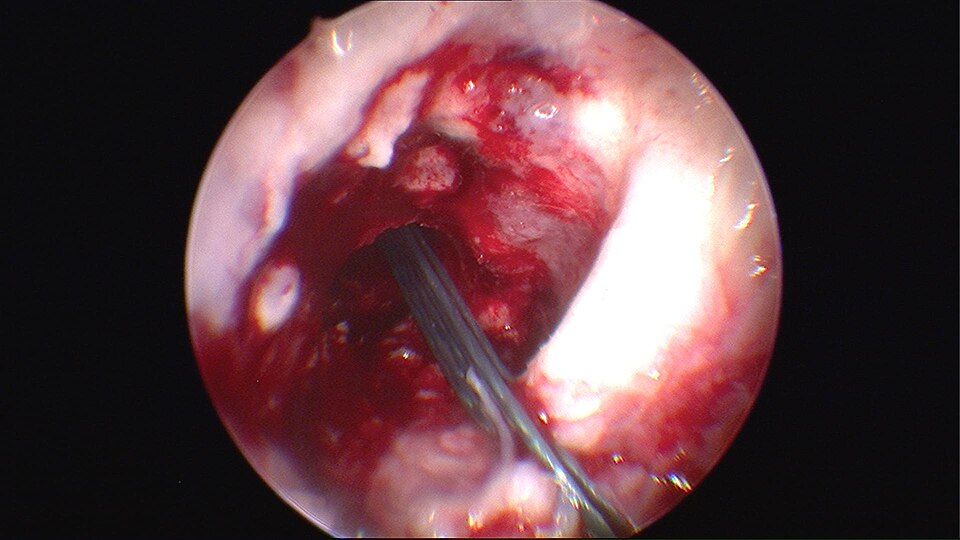 The Hidden Tear That Could Undermine Your ACL Reconstruction