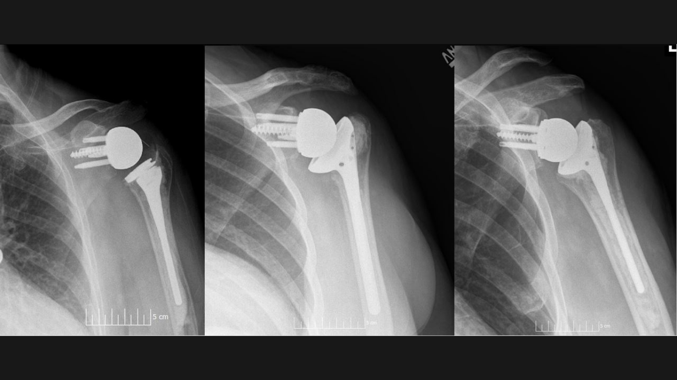 The Forgotten Motion After Reverse Shoulder Arthroplasty