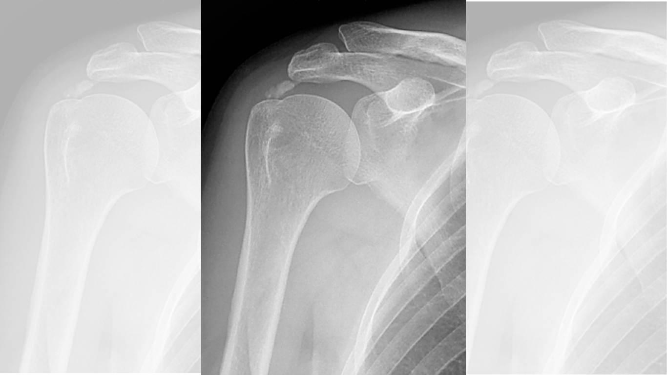After 7 Years, Shockwave Patients Had Fewer Re-Ops