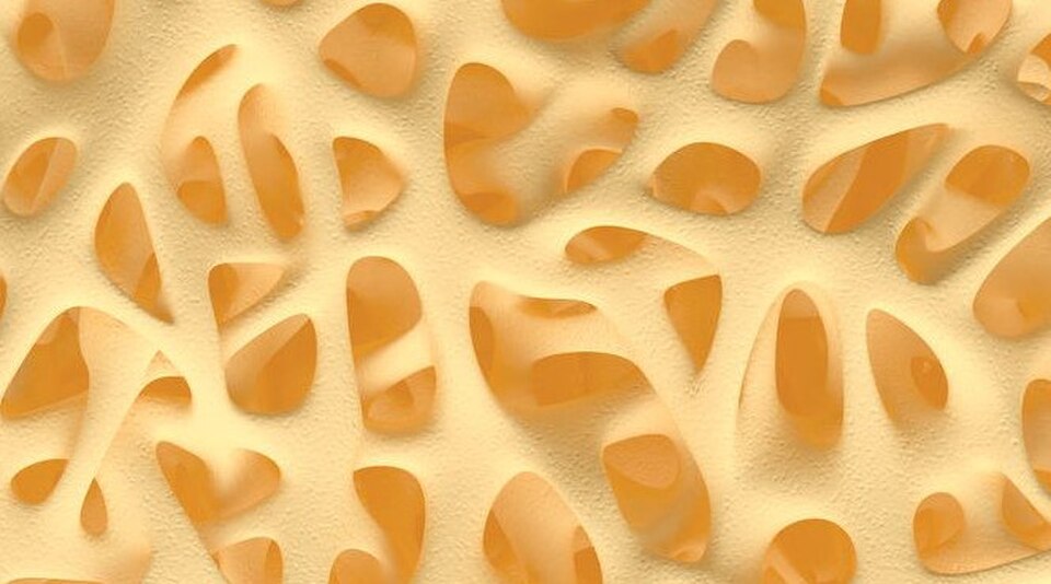 Anabolic Bone Therapy Cuts Junctional Failure Risk 49%