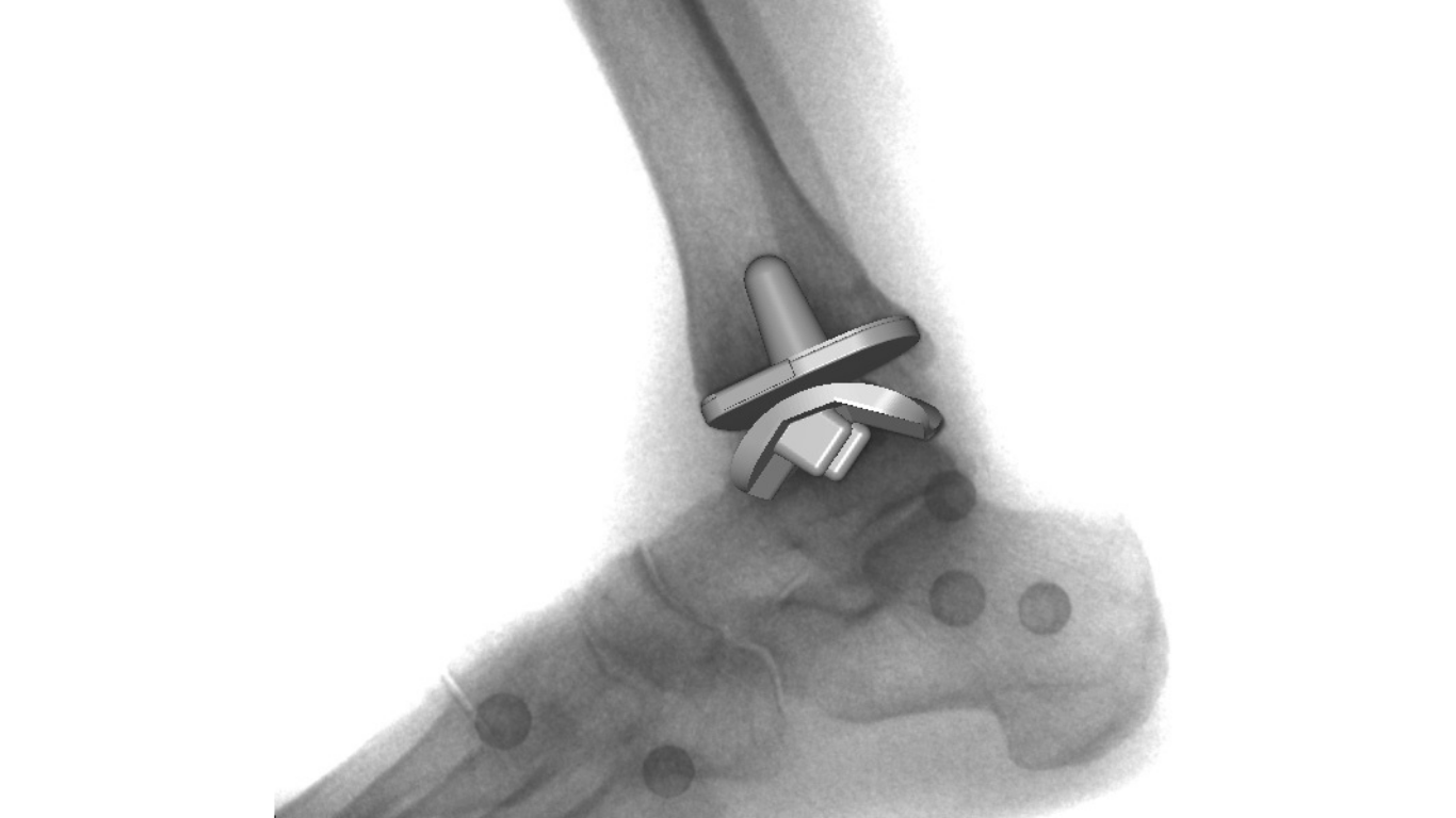 More Metal, Same Problem? Obesity and Earlier Failure After Total Ankle Arthroplasty