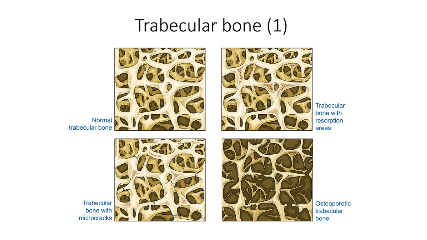 The “Borderline” Bone Density Result That May Not Be So Benign After Joint Replacement