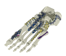Pace Surgical Tempo System.png