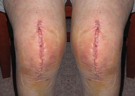 Bilateral Knee Patients: Complication Rates Increasing
