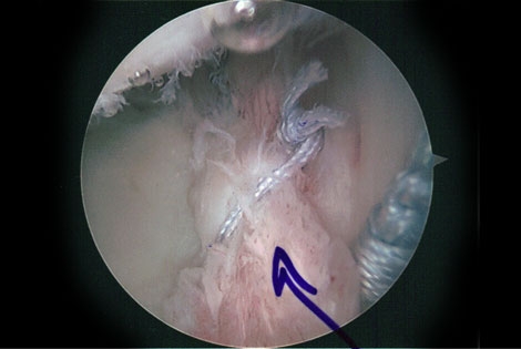 Therapy Tops Surgery for SLAP Tears