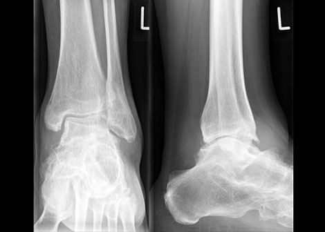 Mayo Team Develops Risk Score for Infection