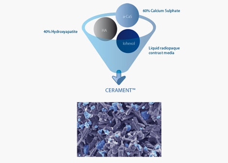 Biomet to Distribute CERAMENT Bone Filler