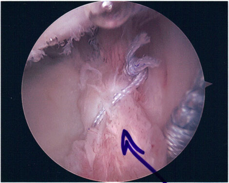 New Treatment for Shoulder SLAP Tear