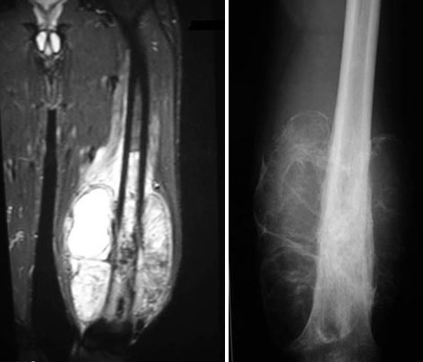 Bone Cancer: Can the Limb be Spared?