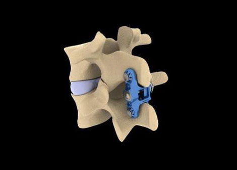 OsteoMed Spine Adds New Implants