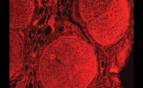 Repairing Nerves With Allograft