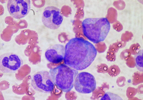 PRP Treatment for Cartilage Tears