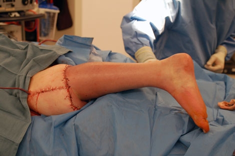 Leg Reversed and Reattached