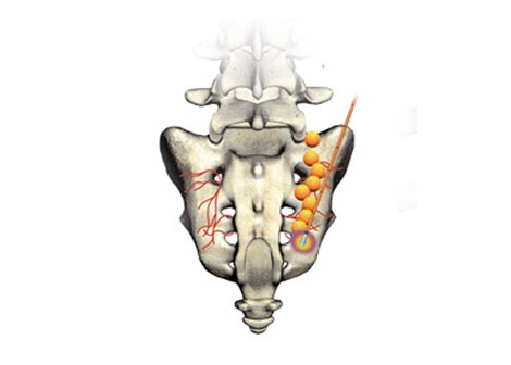 Cooled Radiofrequency Procedure Coverage in NJ