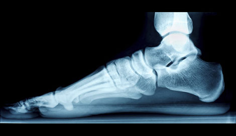 MedShape, Inc. Introduces DynaNail