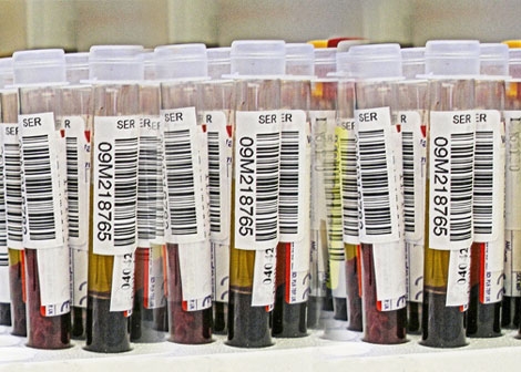 Blood Test to Track RA Progression