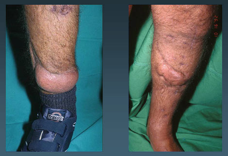 The Latest in Limb Salvage