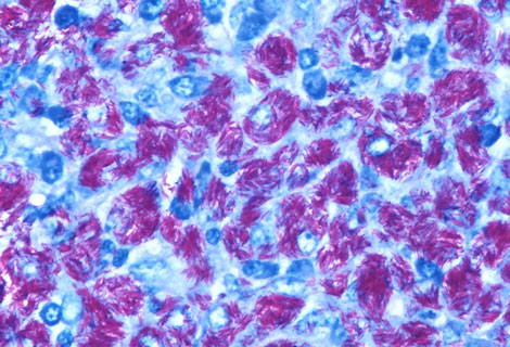 Minimizing Infection in Arthritis Treatment