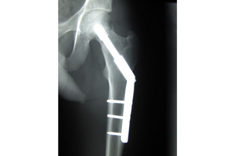 Cataract Surgery Reduces Hip Fractures