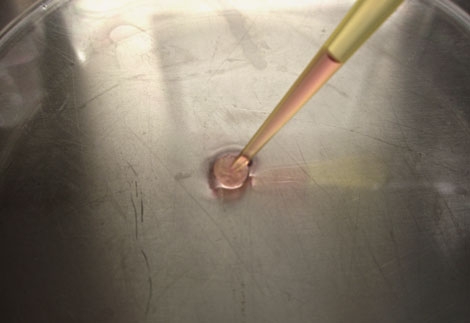 Azellon Recruiting for Meniscus Repair Study