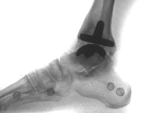 Ankle Replacements –Growing Stepchild of Hips & Knees