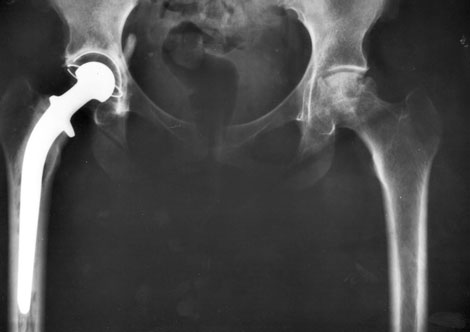 Metal-on-Metal Hip Hazard Alert and Litigation Update