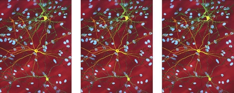 Stem Cell Breakthrough on Huntington’s