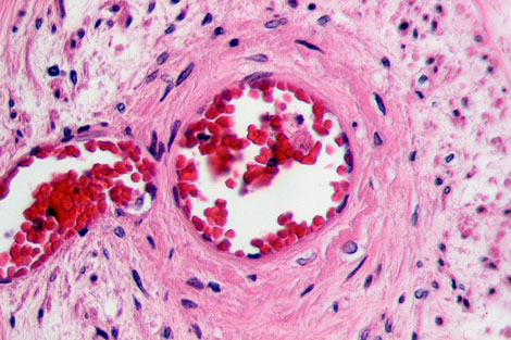 Stem Cells Treat Critical Limb Ischemia