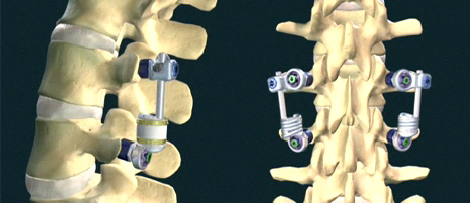 Spinal Motion Preservation: Update and Outlook (Part 3 of 3)