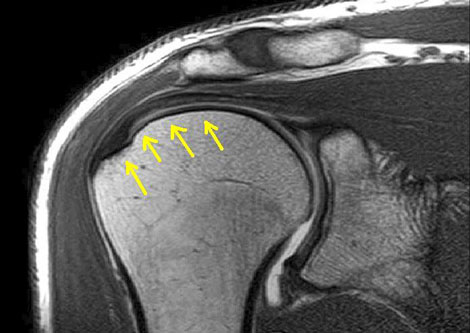 Aging Stem Cells Affect Rotator Cuff Healing? and More…
