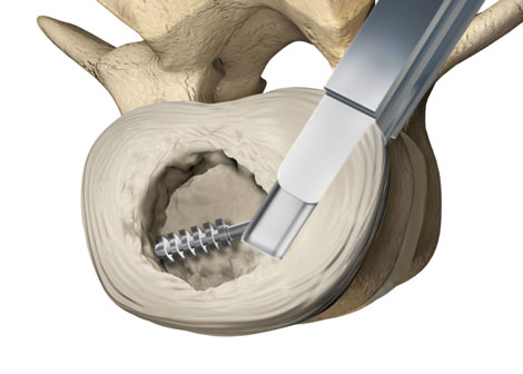 NLT SPINE: 510(k) Clearance for eSPIN