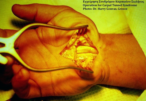 Carpal Tunnel Research: A View Out of the Tunnel