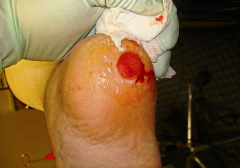 MSC2 (?!) Stem Cells Turn Off Inflammation