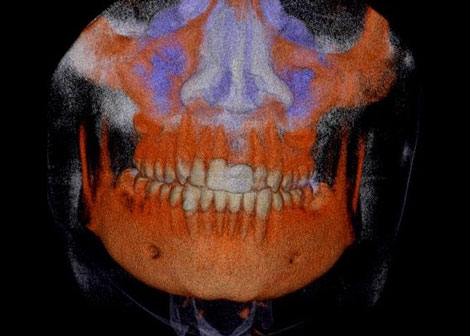 Stem Cells Excel in Jawbone Reconstruction
