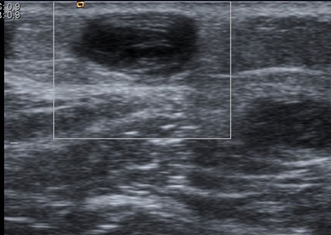 Australian Study Faults Thrombosis Treatment