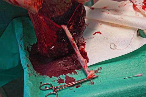 Umbilical Cord Cells Outperform Marrow Cells