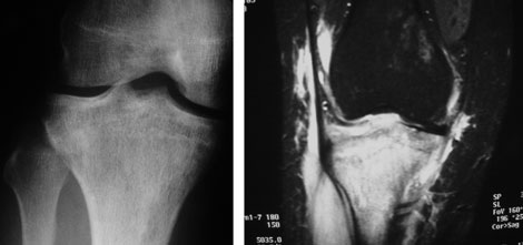 Sarcomas: What Do You Know?