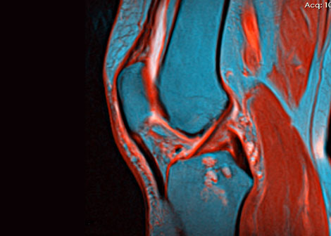 Go Duke! Researchers Create Joint Cartilage