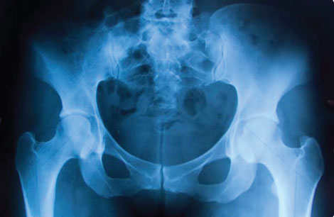 Yes, Virginia, You Can Resurface Hips