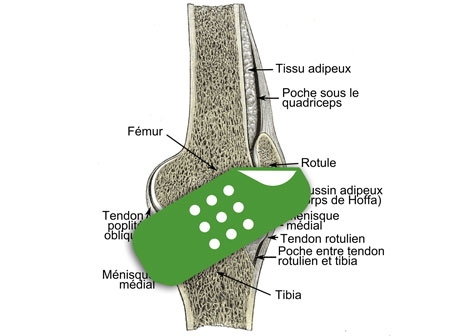 Windpipe Doc Invents Torn Meniscus Bandage